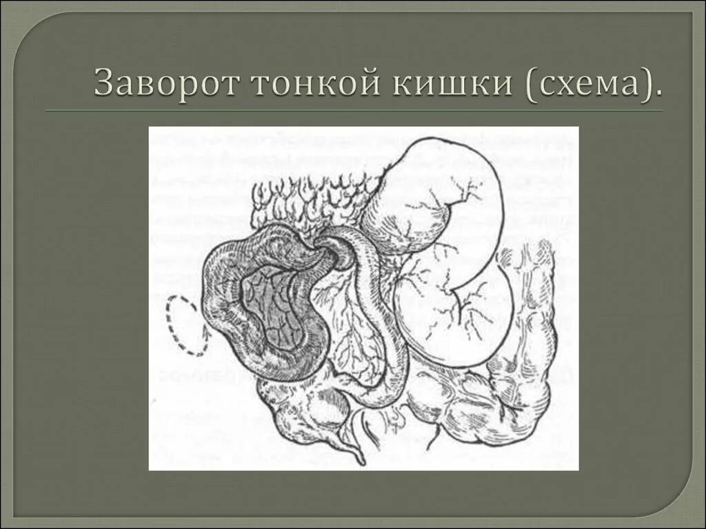 От чего может быть заворот. Операции при завороте сигмовидной кишки. заворот сигмовидной кишки рентген. заворот сигмовидной кишки кт. илеоцекальный заворот.