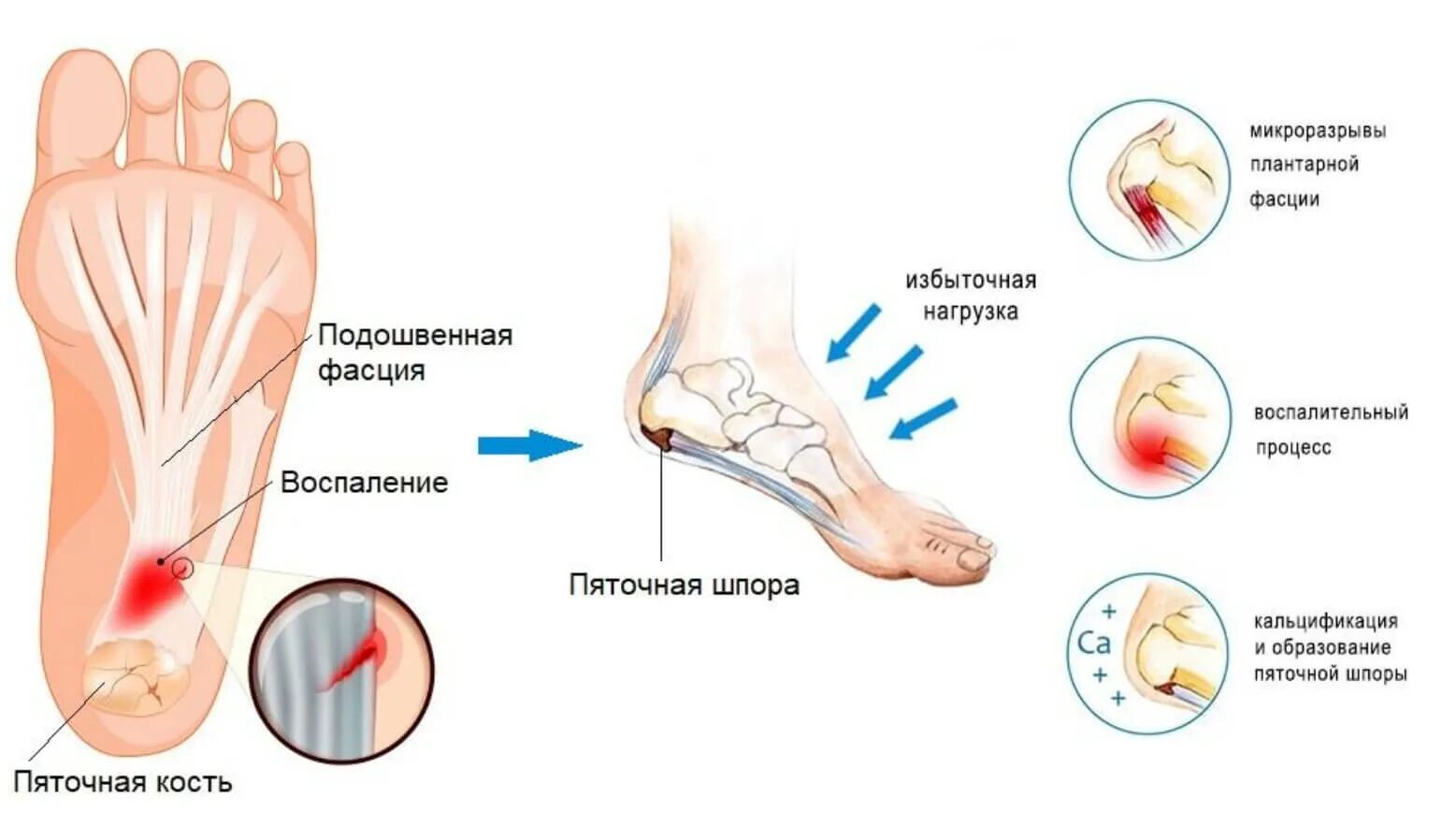 Подошвенная пяточная шпора. Пяточная шпора и подошвенный фасциит. Болят пятки чем лечить в домашних