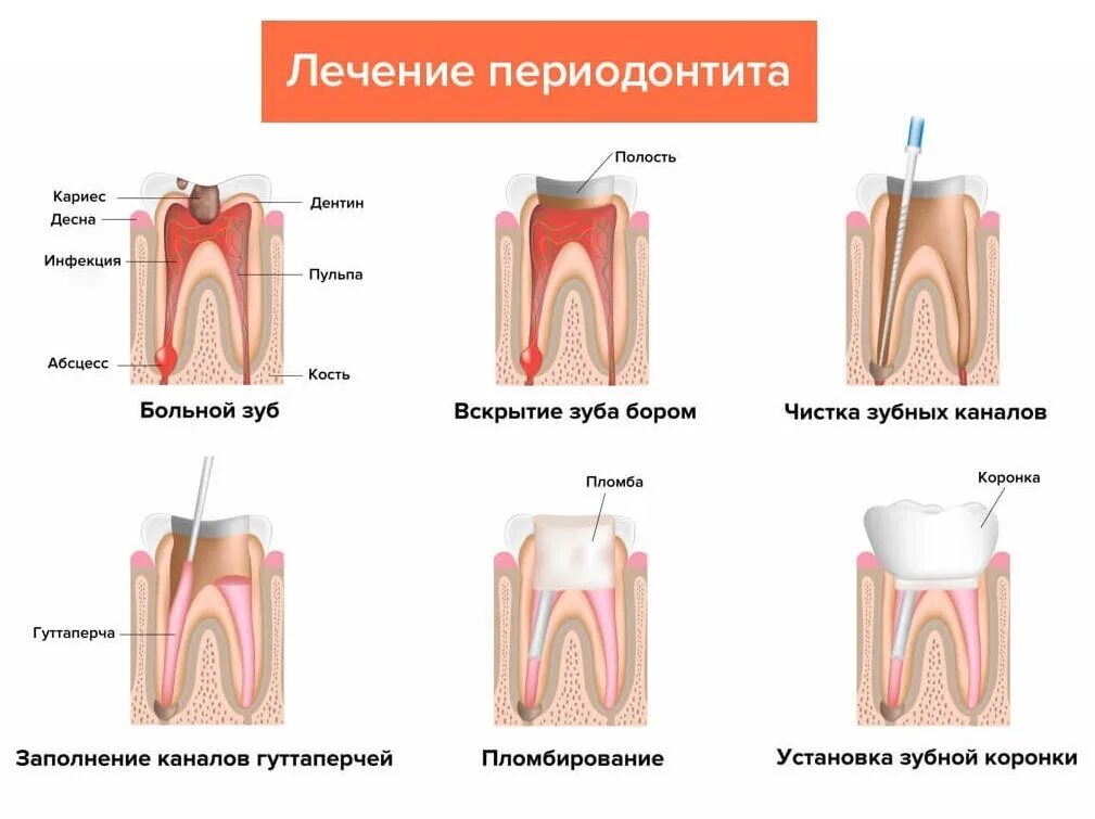 Как называется зуб после. Хронический периодонтит пульпит. периодонтит 3 корневого зуба. хронический фиброзный периодонтит схема. схема этапы лечения воспаления корня зуба.