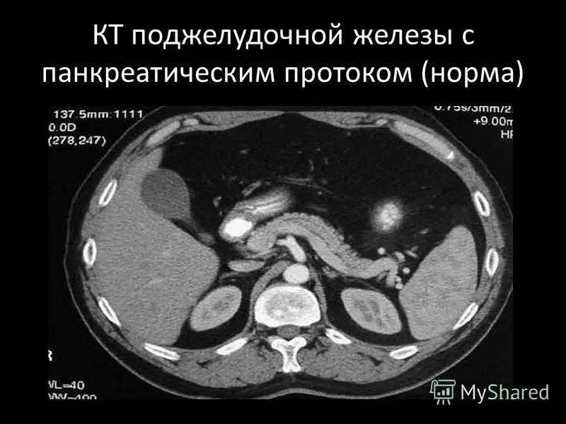 поджелудочная железа на кт с контрастом. томограмма брюшной полости кт. кальцификация поджелудочной железы на кт. панкреонекроз поджелудочной железы кт. кт поджелудочная железа обызвествление стенки.