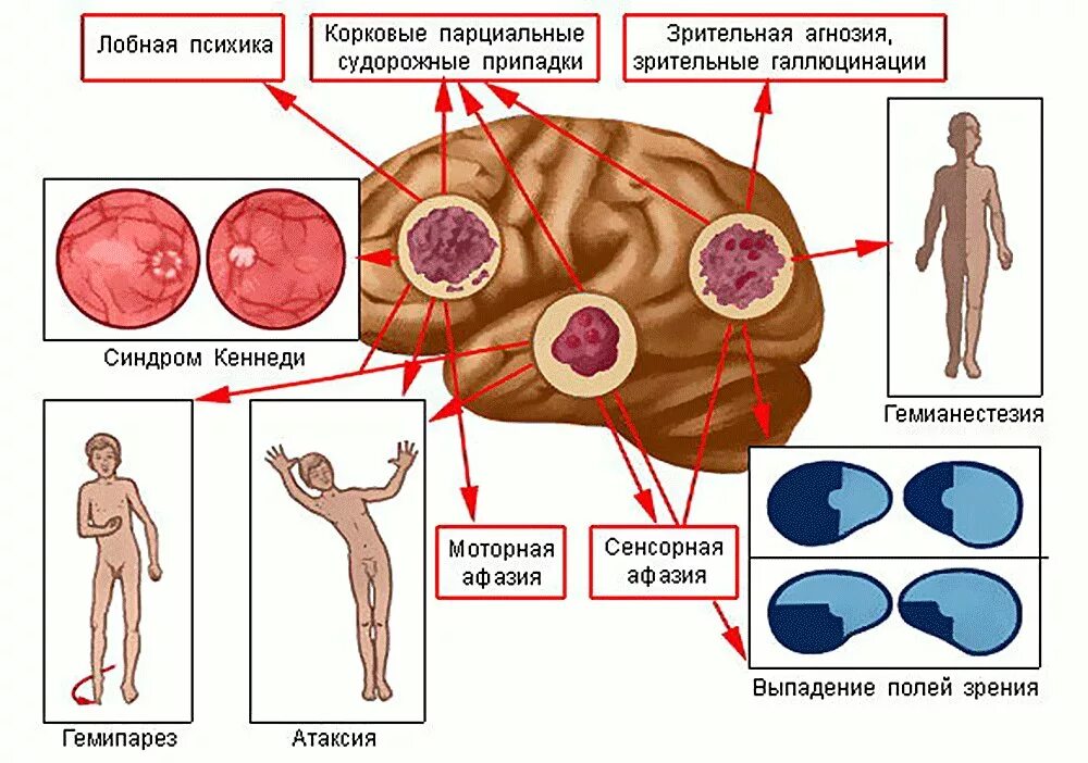 Опухоль головного мозга симптомы. Симптоматика опухолей головного мозга. Опухоль головного мозга симптомы на ранних стадиях. Признакиопухали в Головм мозге.