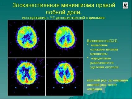Опухоли правой лобной доли