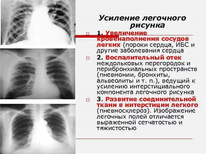 Прикорневой отдел легких