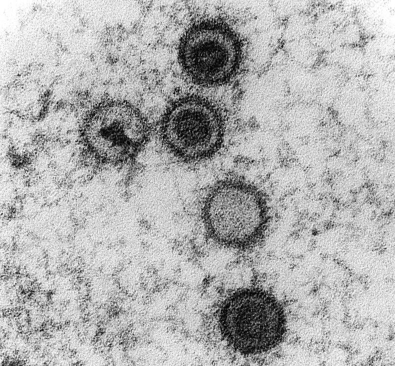 Вирус Эпштейна-Барр под микроскопом. Вирус Эпштейна Барр электронная микроскопия. Вирус Эпштейна-Барр микроскоп. Герпесвирус Эпштейна-Барр что это. Вирус epstein barr virus