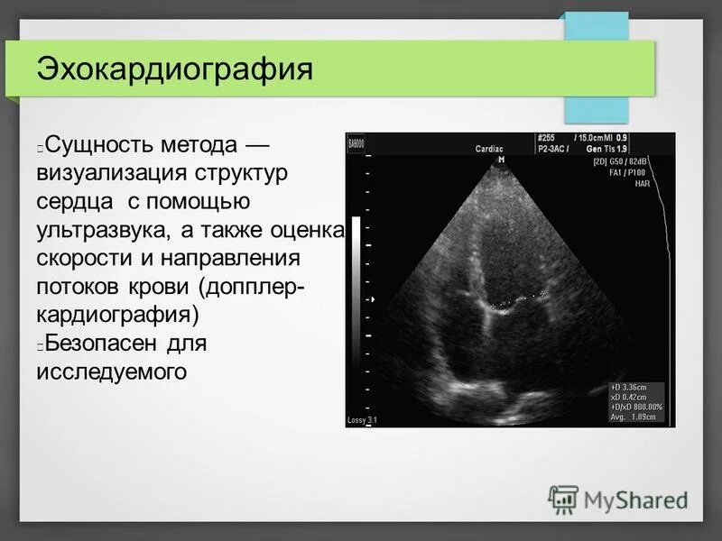 Эхо кардиография. Методика ЭХОКГ. Методы эхокардиографии. Эхокардиография суть метода. ЭХОКГ методика проведения.