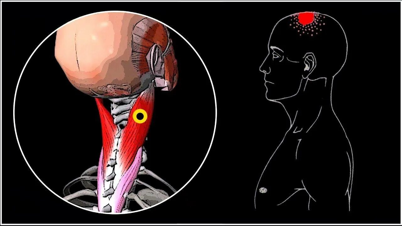 Болит голова и мышцы шеи. Ременная мышца головы триггерные точки. Ременная мышца шеи триггерные точки. Миофасциальные триггерные точки головы. Триггерные точки ременных мышц головы и шеи.