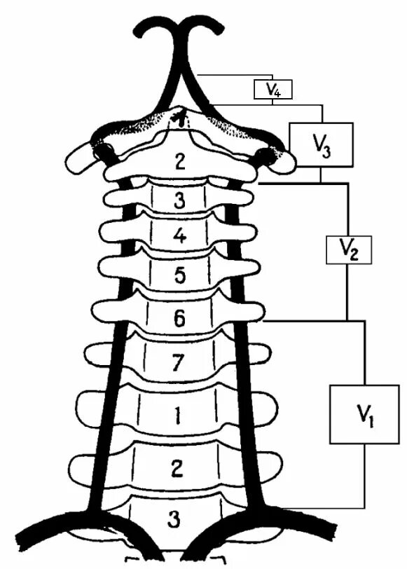 Сегмент v1 позвоночной артерии. V3 сегмент позвоночной артерии. Сегменты v1 v2 позвоночных артерий. Сегмент v1 v2 позвоночной артерии.