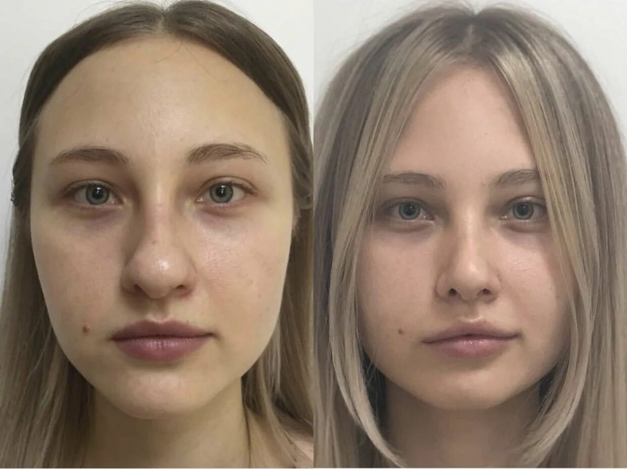 Тео ринопластика. Пластика носа. Пластика носа. Ринопластика курносого носа. Ринопластика до и после.