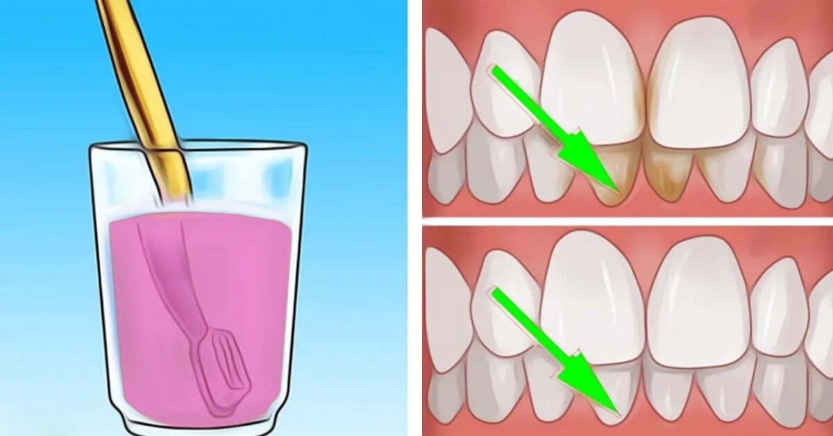 Зубной какамекакамень. Как чистить десна