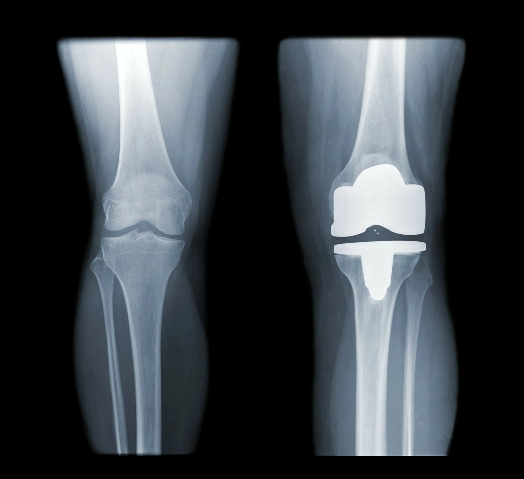 Эндопротезирование коленного сустава. Артроз коленного сустава эндопротез. Артропластика коленного. Эндопротез коленного сустава.