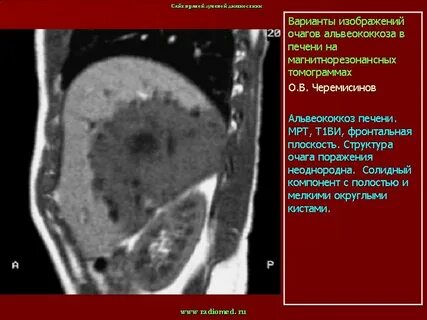 Диагностика эхинококкоза печени