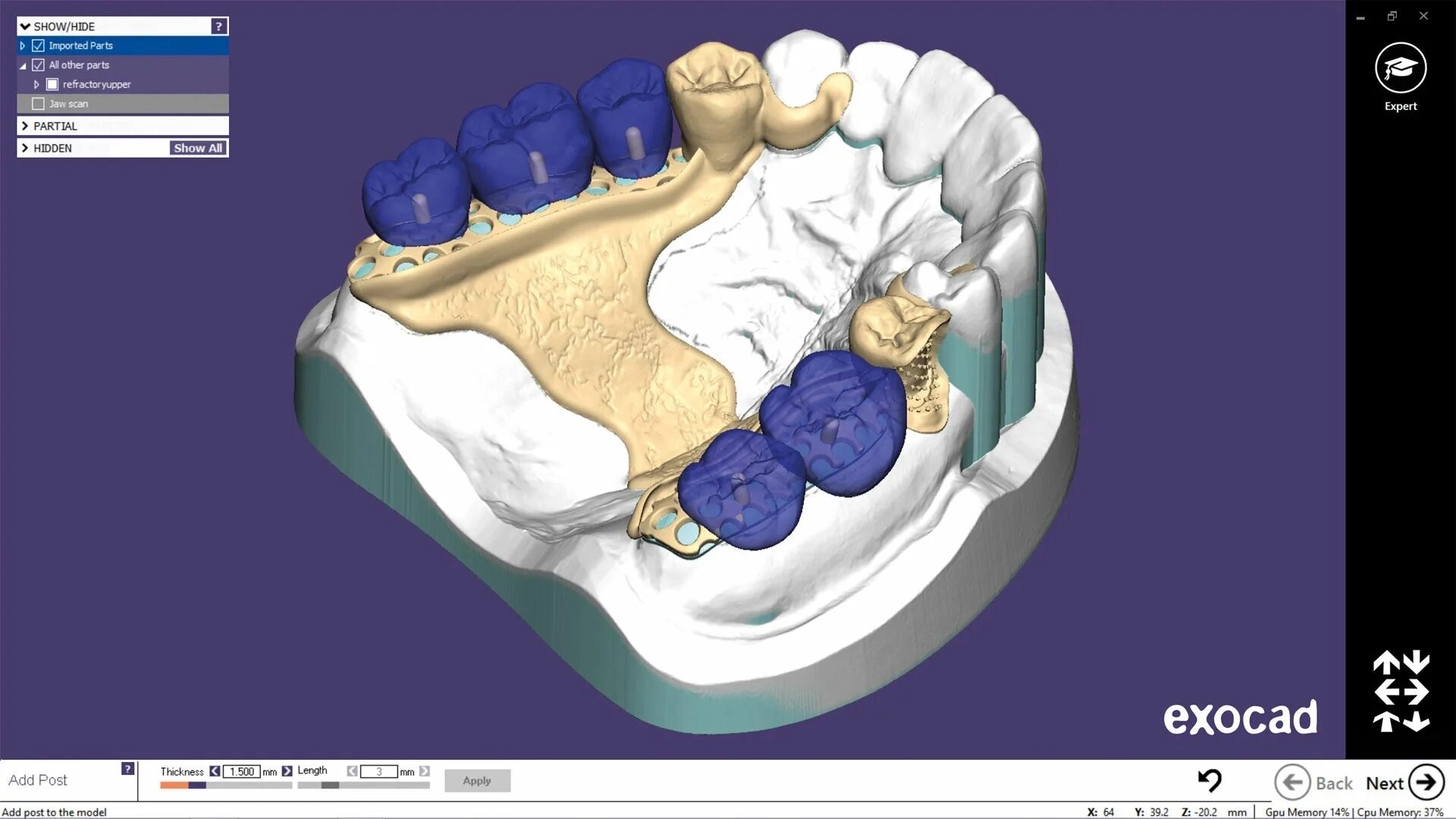 Cad cam моделирование. Cad/cam моделирование exocad. cad cam бюгельные протезы. каркасы бюгельных протезов cad/cam. бюгельный протез exocad.