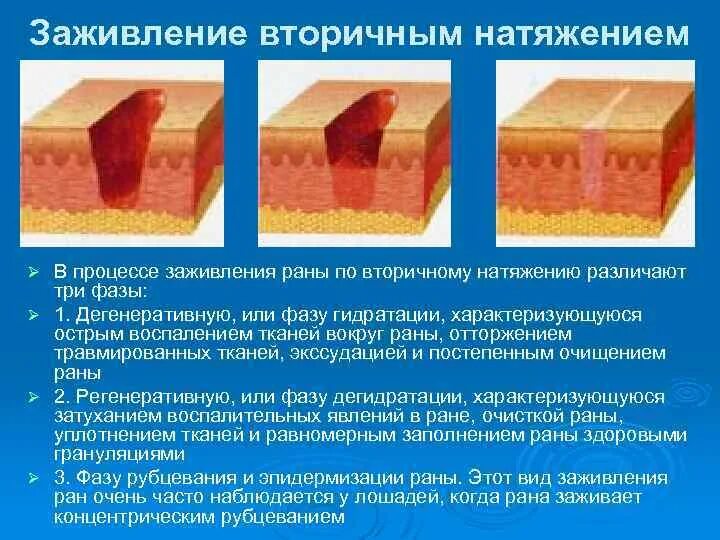 Может ли зажить трещина. Заживление РАН грануляционная ткань. Первичное и вторичное натяжение заживление РАН. Стадии заживления РАН вторичным натяжением. Этапы вторичного заживления РАН.