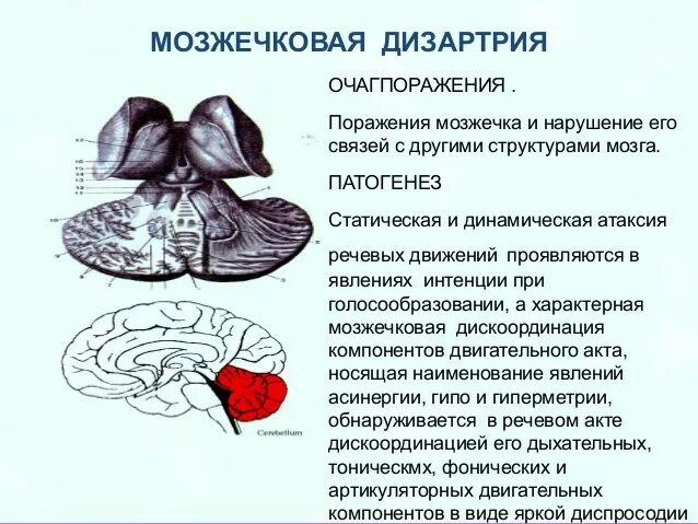 Нарушение функции мозжечка. Дизартрия при поражениях мозжечка. Мозжечковая дизартрия очаг поражения. Мозжечковая дизартрия патогенез. Симптомы поражения мозжечка дизартрия.