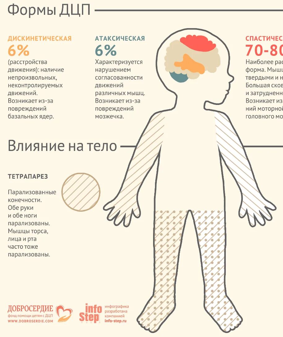 Легкая форма дцп. Формы ДЦП У детей таблица. ДЦП 4 степени у детей. Причины и клинические проявления ДЦП таблица. Средняя форма ДЦП.