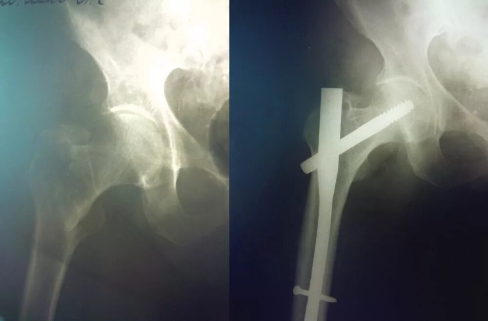 Сломана шейка бедра операция. Остеосинтез чрезвертельного перелома. Чрезвертельный перелом бедренной кости остеосинтез. Чрезвертельный перелом бедра остеосинтез. Остеосинтез тазобедренного сустава рентген.