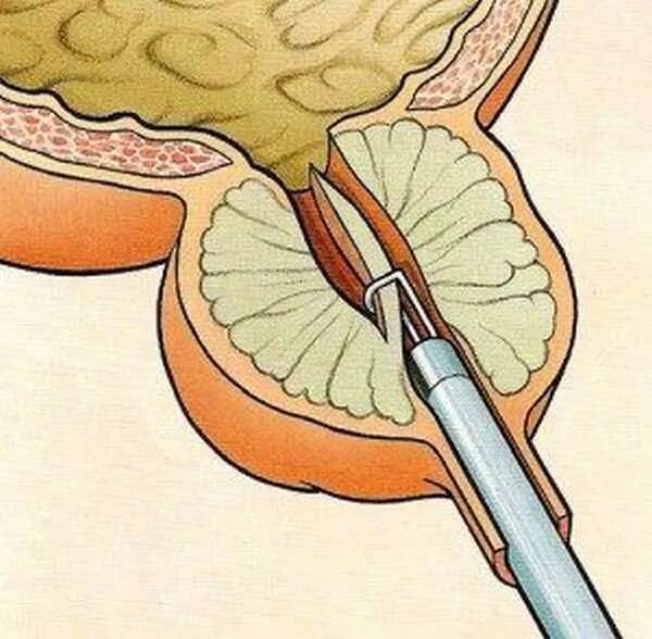 Тур урология. Трансуретральная резекция предстательной железы. Трансуретральная резекция предстательной железы тур. Пункционная биопсия предстательной железы. Трансуретральная резекция аденомы предстательной железы.