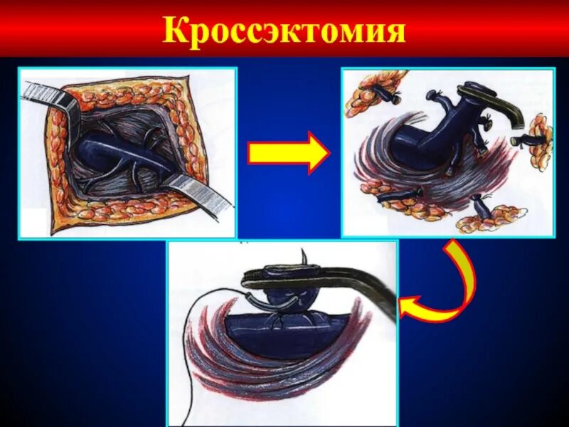 Операция троянова-тренделенбурга. Кросэктомия. Кросэктомия. Операция троянова-тренделенбурга. Кроссэктомия ход операции.