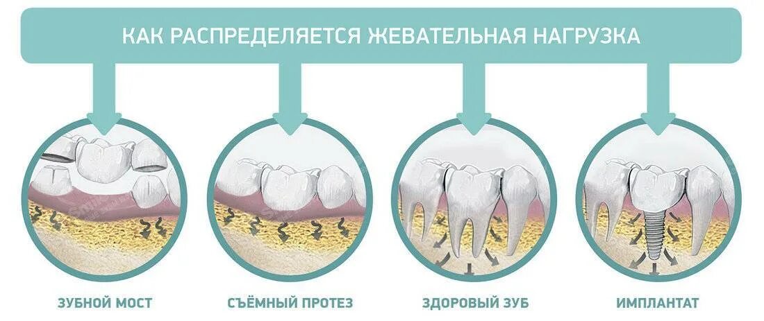 Этапы заживления лунки зуба.