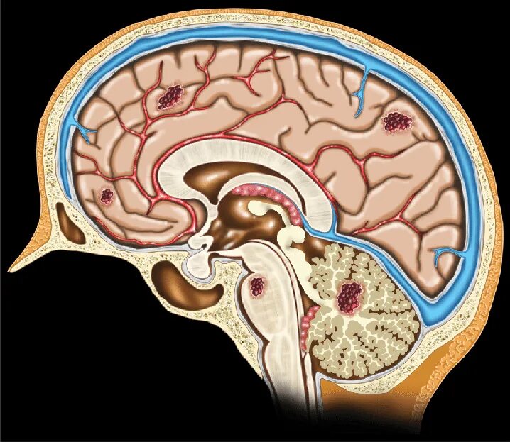 Кавернозная кавернома. Кавернома головного мозга. Кавернома ствола мозга.