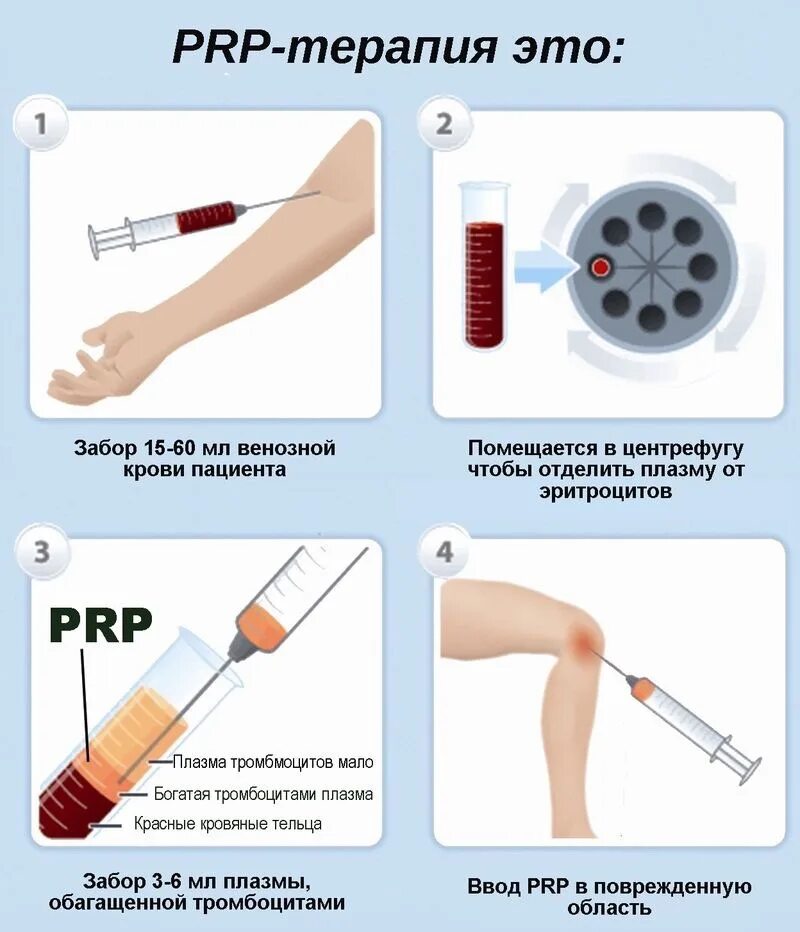 Процедура плазмолифтинга для суставов. PRP терапия Platelet Rich Plasma. PRP-терапию (плазма обогащенная тромбоцитами). Плазмотерапия суставов (PRP-терапия, плазмолифтинг).