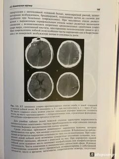Очаговая черепно мозговая травма