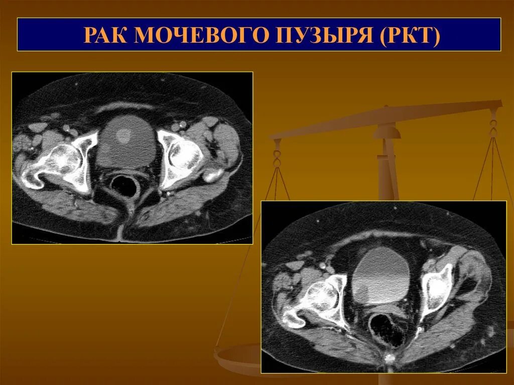 Аномалия мочевого. Эпителиальные опухоли мочевого пузыря. Патология мочевого пузыря мрт. Эпителиальное образование мочевого пузыря.