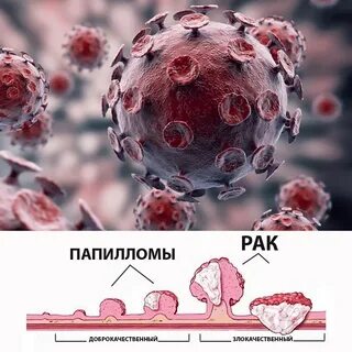 Вирус папиллома матки