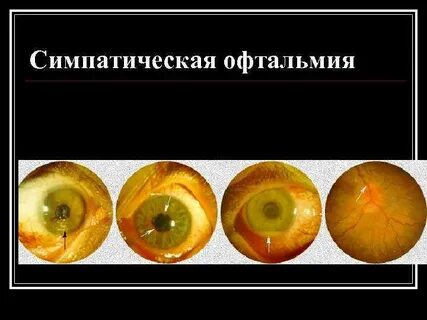 Симпатическая офтальмия это