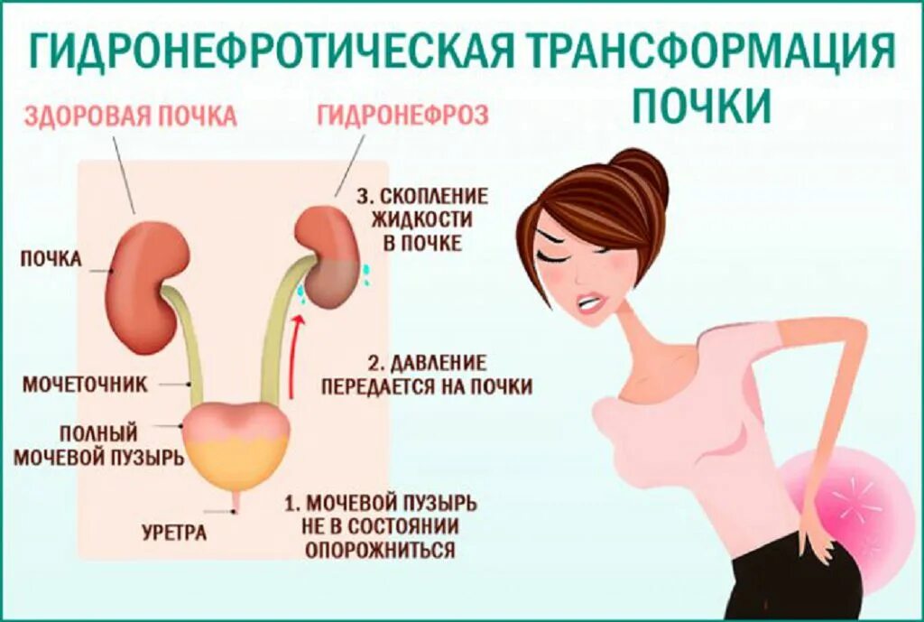Почему расширенные почки. Гидронефроз трансформация почки. гидронефроз левой почки 2ст. симптомы гидронефротической трансформации почки. гидронефротическа трансфоремация лефой почки.