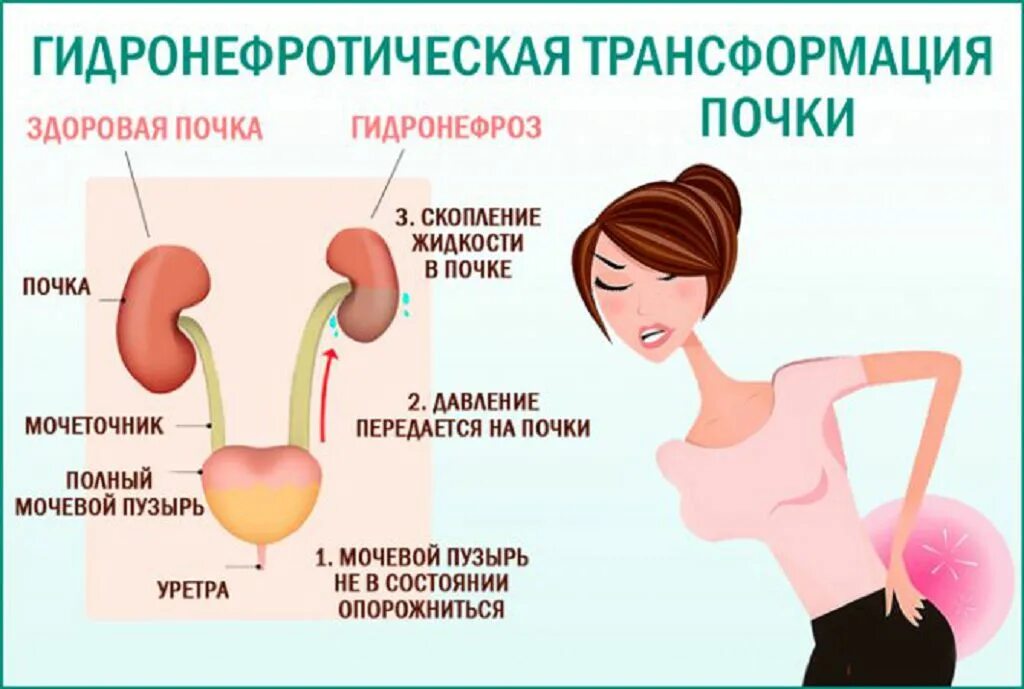 Заболевание почек гидронефроз. Гидронефроз трансформация почки. Гидронефроз левой почки 2ст. Симптомы гидронефротической трансформации почки. Гидроуретеронефротическая трансформация почки.