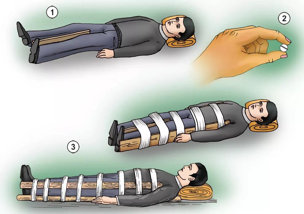 Перелом позвоночника транспортная иммобилизация. ПМП при переломе позвоночника. Транспортная иммобилизация шейного отдела позвоночника. Оказание 1 помощи при переломе позвоночника.