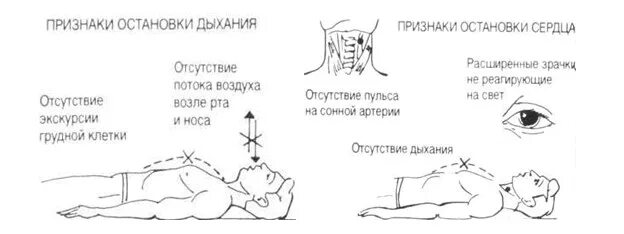 Остановка сердца и дыхания симптомы. Остановка дыхания и сердца симптомы и первая помощь. Остановка дыхания и сердечной деятельности признаки первая помощь. Определите признаки остановки сердца и дыхания..