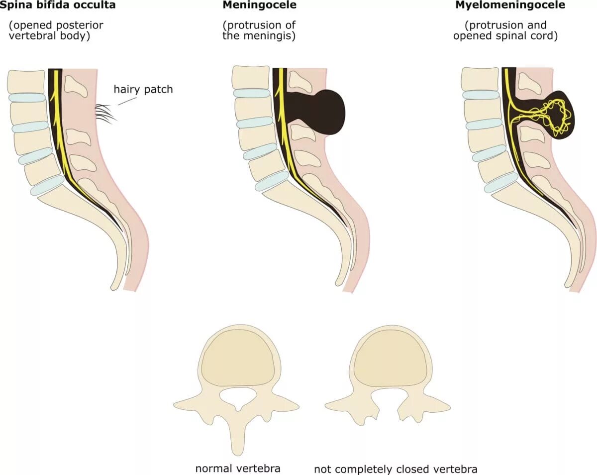 Аномалии развития нерва. Спинномозговая грыжа spina Bifida. Spina Bifida (расщепление позвоночника). Пороки развития нервной трубки плода. Расщелина позвоночника (spina Bifida).