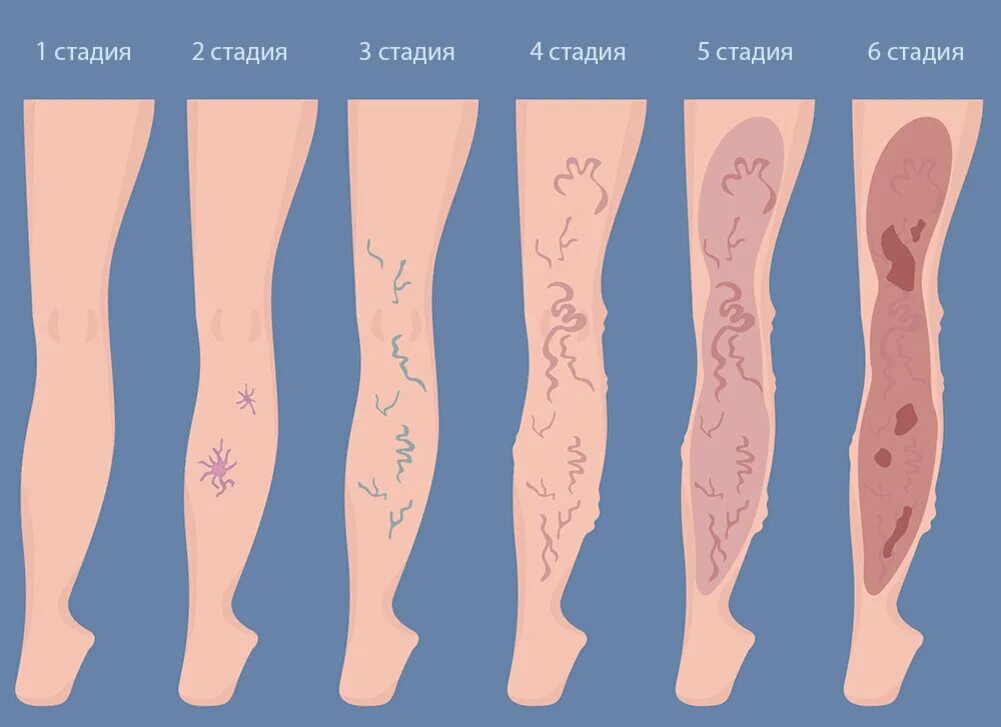 Варикозное расширение вен на ногах. Трофические язвы варикоз. Варикозное расширение вен стадии. Варикоз расширение вен нижних конечностей. Что значат вены на ногах