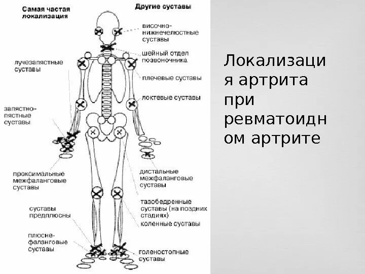 Названия суставов человека. Схема поражения суставов при ревматоидном артрите. Поражение суставов при ревматоидном артрите. Ревматоидный артрит локализация поражения суставов. Ревматоидный артрит дас 28 суставы.