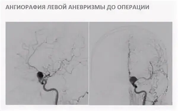 Форум аневризма мозга. Трепанация черепа операция аневризма. Аневризма головного мозга с трепанацией черепа. Аневризма после операции. Операция аневризма головы.