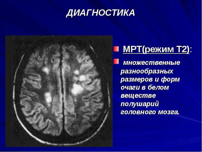 Глиоз в веществе головного мозга что такое