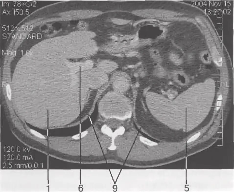 Брюшная полость мрт анатомия. Краниокаудальный размер печени на кт. Кт анатомия брюшной полости нормы. Кт печени и селезенки норма. Кт норма печень