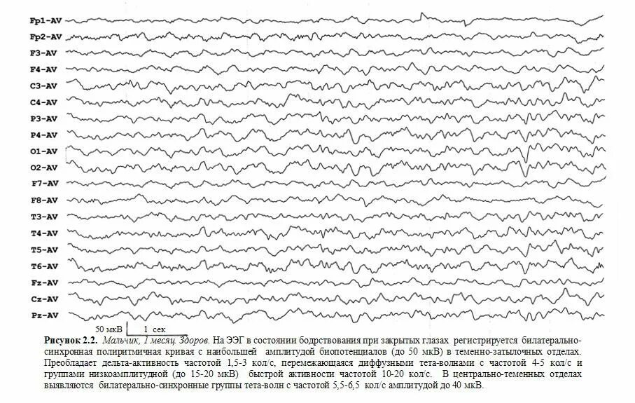 Реакция ээг. Нормальная диаграмма ЭЭГ. Эпилепсия на ЭЭГ. Височная эпилепсия на ЭЭГ. ЭЭГ норма и патология у взрослых.