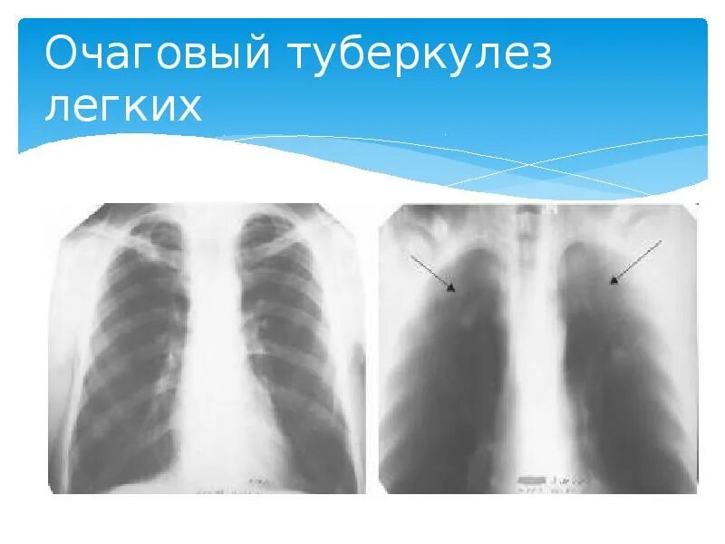 Очаг в верхушке легкого. Очаг в верхушке легкого. Очаговый туберкулез рентген. Очаг в верхушке легкого. Фиброзно очаговый туберкулез рентген.