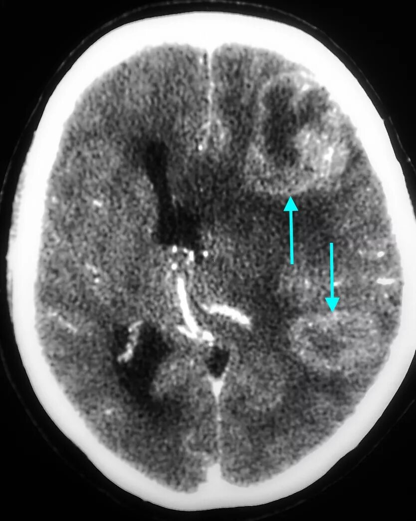 Меланома метастазы в мозг. Метастазы меланомы в головной мозг кт. Метастазы головного мозга кт кт. Метастазы меланомы в головной мозг мрт. Опухоли и метастазы головного мозга на кт.