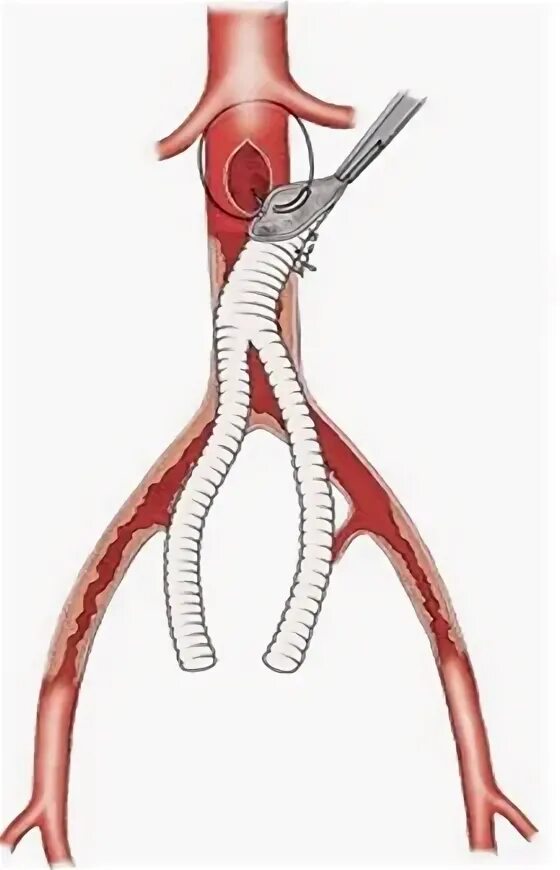 Атеросклероз аорты шунтирование. Шунтирование сосудов нижних конечностей. Синдром Лериша шунтирование. Аортобедренное шунтирование.