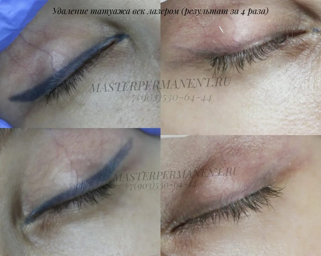 удаление татуажа век отзывы