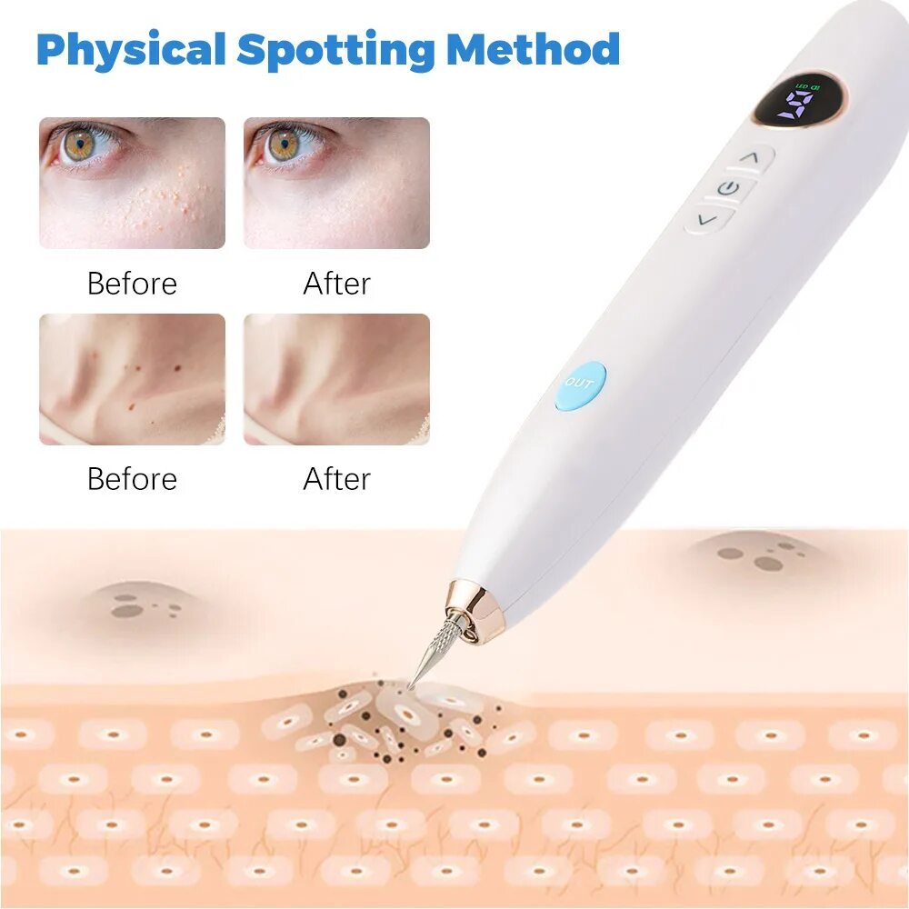 Mole removal pen насадка. Лучшая лазерная ручка для удаления папиллом. Лазерная ручка для удаления папиллом. Beauty mole removal sweep spot pen. Удаление папиллом плазменной ручкой.