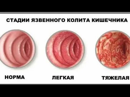 Колит лечение у взрослых препараты отзывы