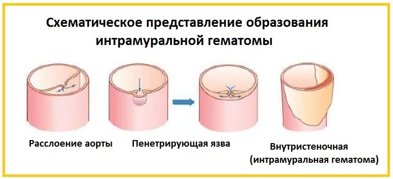 Гематома аорты. Интрамуральная гематома сонной артерии. Разрыв брюшной аорты узи. Интрамуральная гематома аорты кт. Гематома аорты.