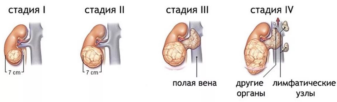 Новообразование 4 степени почки. 4 стадия злокачественная