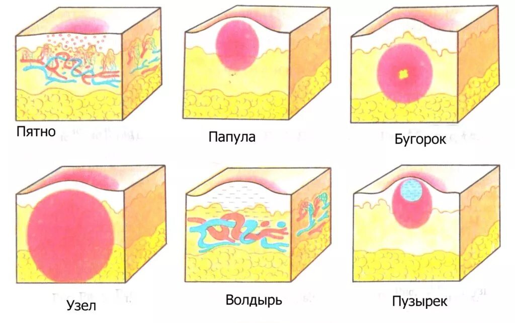 Папула вторичные элементы. Морфологические элементы сыпи папула. первичные морфологические элементы кожи пустула. папула пустула пятно пустула.