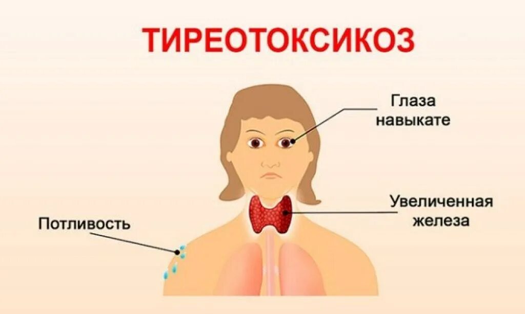 Гипертиреоз лечение у мужчин. Эрготоксикоз это. Тиреотоксикоз щитовидной железы. Гипертиреоз щитовидной железы.